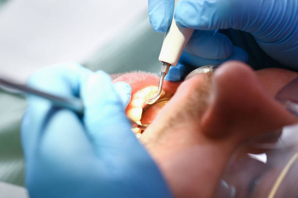 Best Emergency Root Canal Treatment in Zeeland, MI
