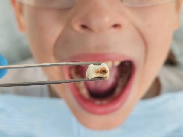 Best Emergency Tooth Extraction in Zeeland, MI